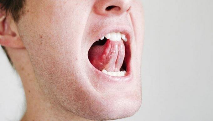 Alguns exercícios simples para a garganta e língua pode aliviar a situação com o ronco. Foto /: i2.wp.com. 